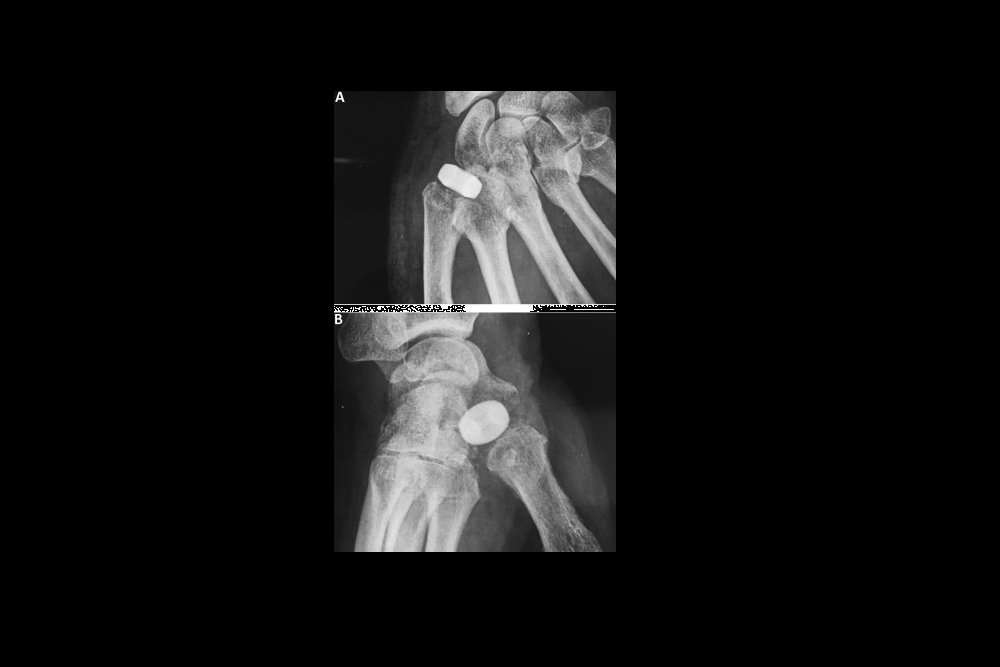 ENSEMBLE ORTHOPEDICS: Receives FDA Clearance For PyroCarbon CMC Interpositional Implant