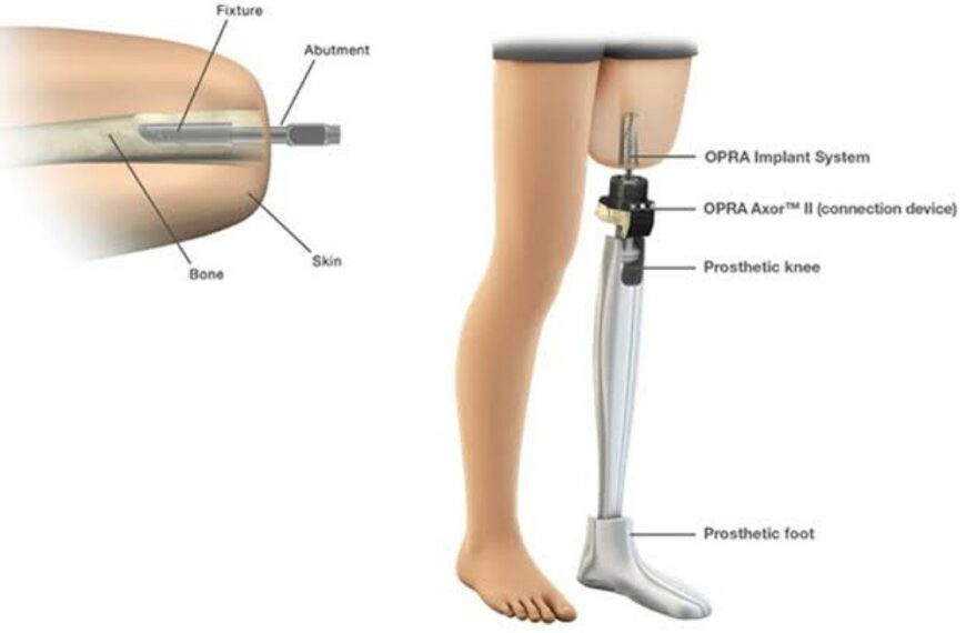 FDA: Approves Prosthetic Implant for Above-the-Knee Amputations